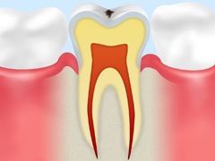 初期虫歯（C0）