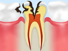 象牙質の虫歯（C2）