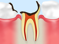 神経の虫歯（C3）