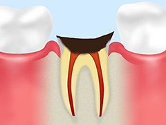 末期の虫歯（C4）