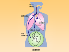 全身疾患と歯周病の関係