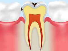 エナメル質の虫歯（C1）