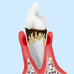 STEP4.重度歯周病
